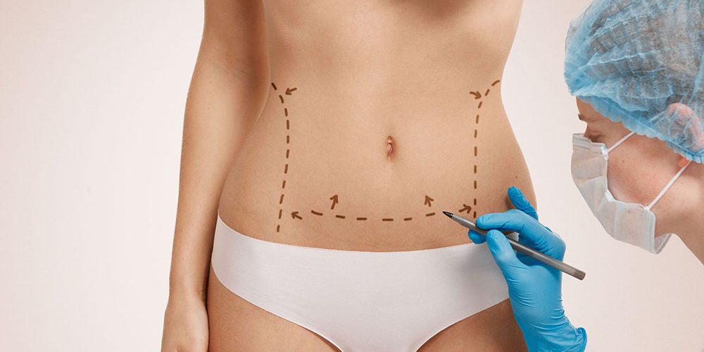 Faster Recovery after Tummy Tuck